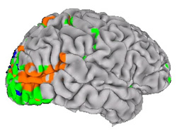 A lateral view of a human brain showing the results of an fMRI experiment in which the subject viewed moving and static figures.