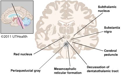 Figure 4. (Click to enlarge) Schematic drawing of subcortical diencephalic and mesencephalic structures.