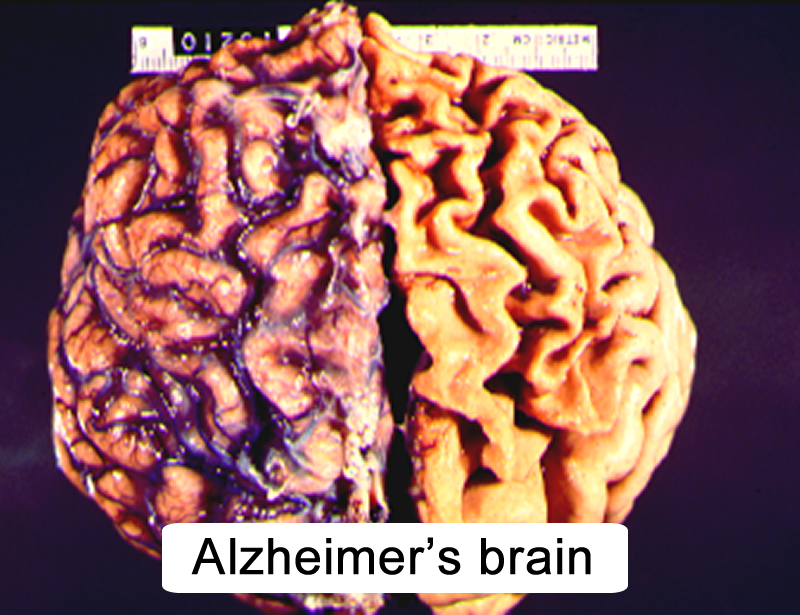 New technique permits cell-specific examination of proteins in Alzheimer's brain tissue