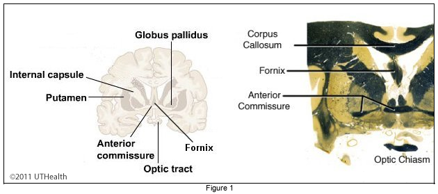 Fornix, Corpus Callosum, Anterior Commissure, Optic Fibers