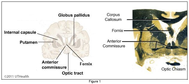 lateral fornix of brain