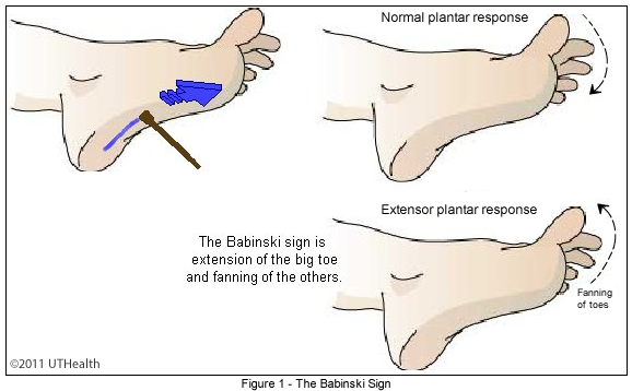 What to Know About the Babinski Reflex