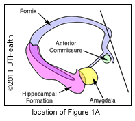 Rostral to Anterior Commissure