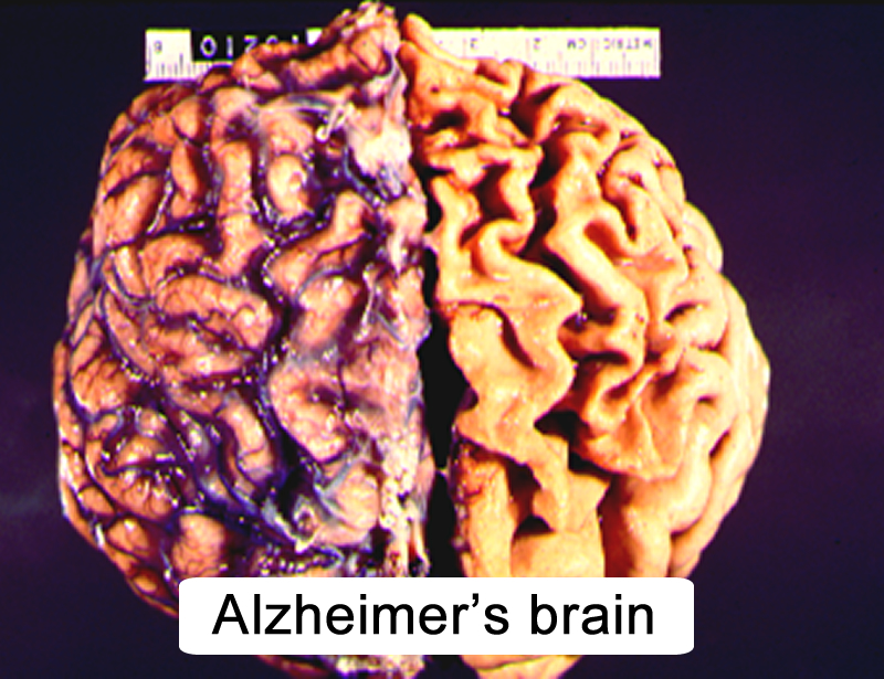 CNS Aging and Alzheimer's Disease (Section 4, Chapter 10) Neuroscience